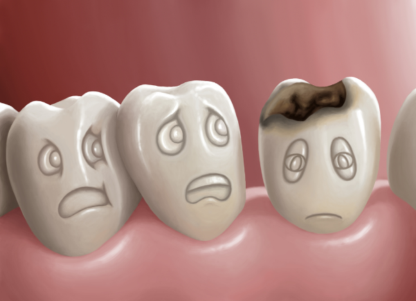 Cavities…Explained!