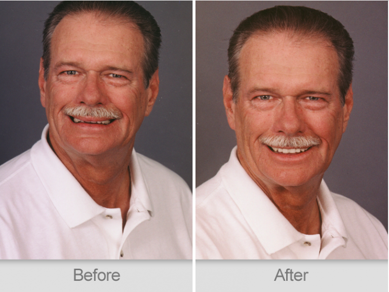 Are You a Candidate for Full Mouth Reconstruction?