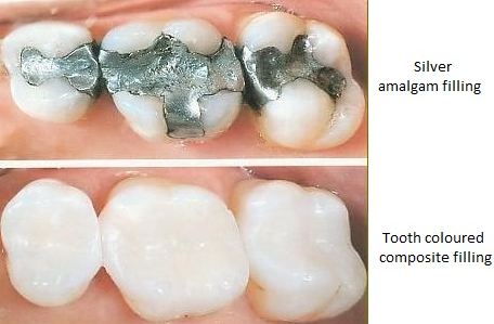 Should Silver Fillings Be Replaced?