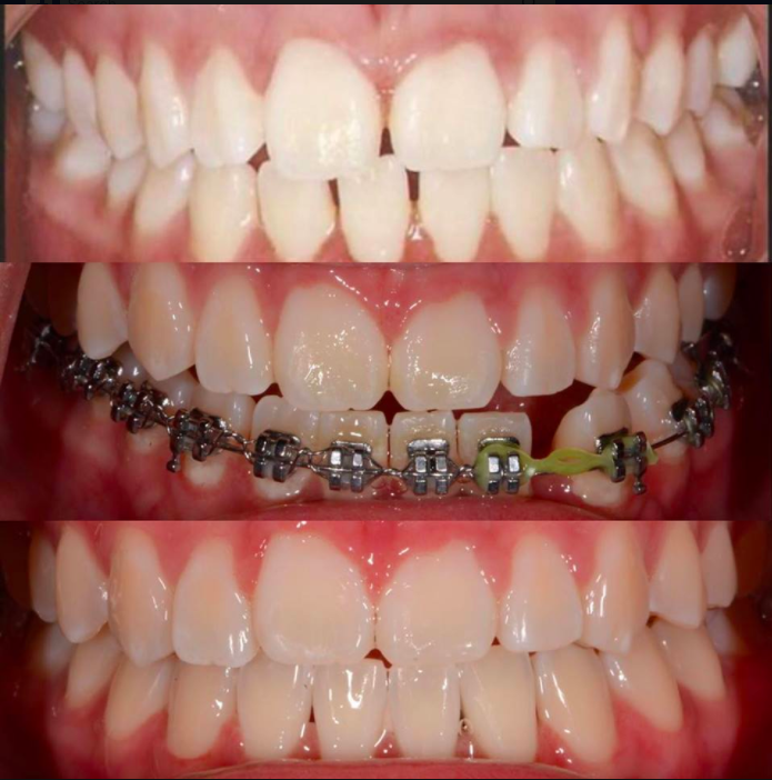Crowded Teeth…what are my options?