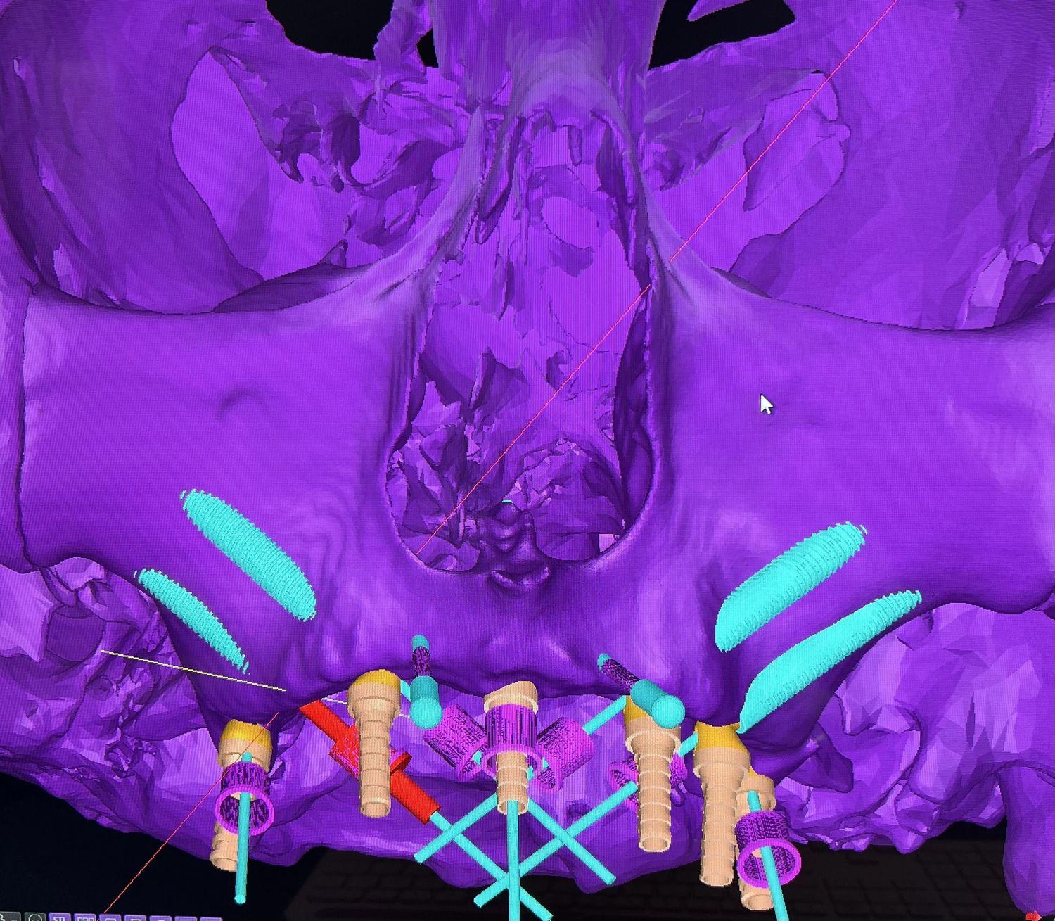 All-On-4 and All-On-6 Dental Implants