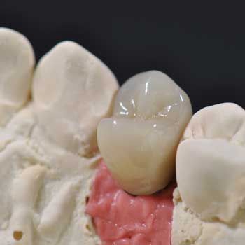 Dental Crown in Marina del Rey