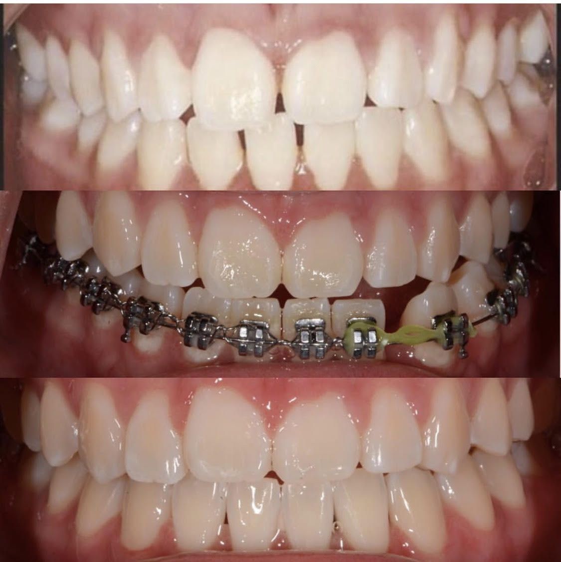 Orthodontic Treatment Before & After