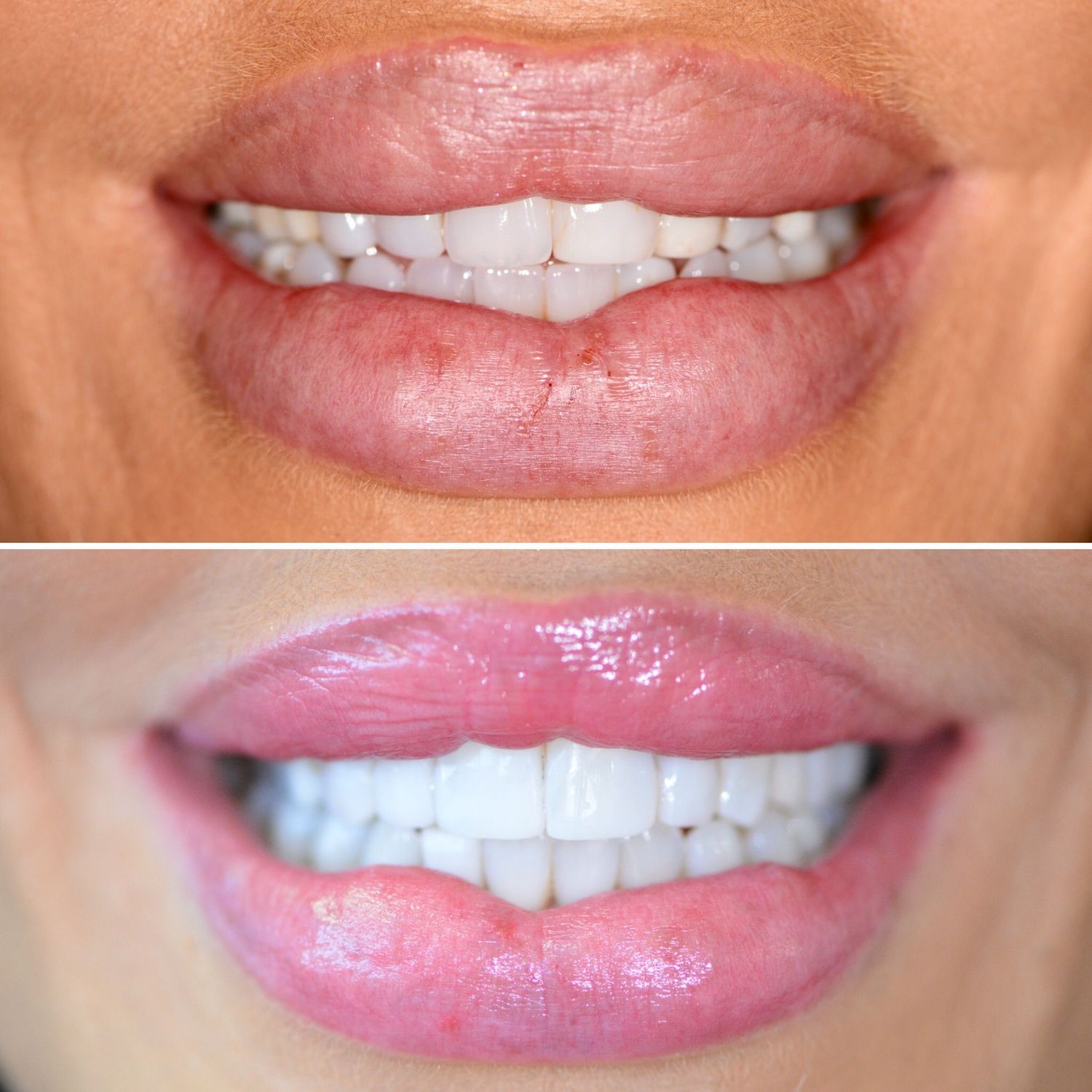 Direct Bonding Before & After