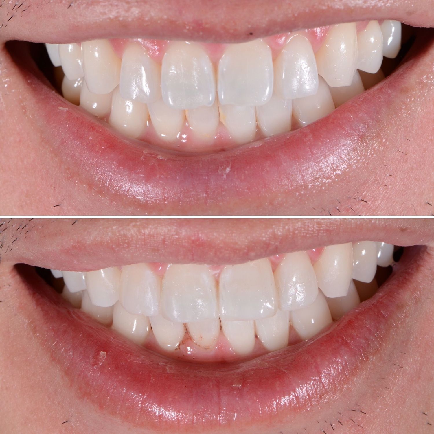 Direct Bonding Before & After