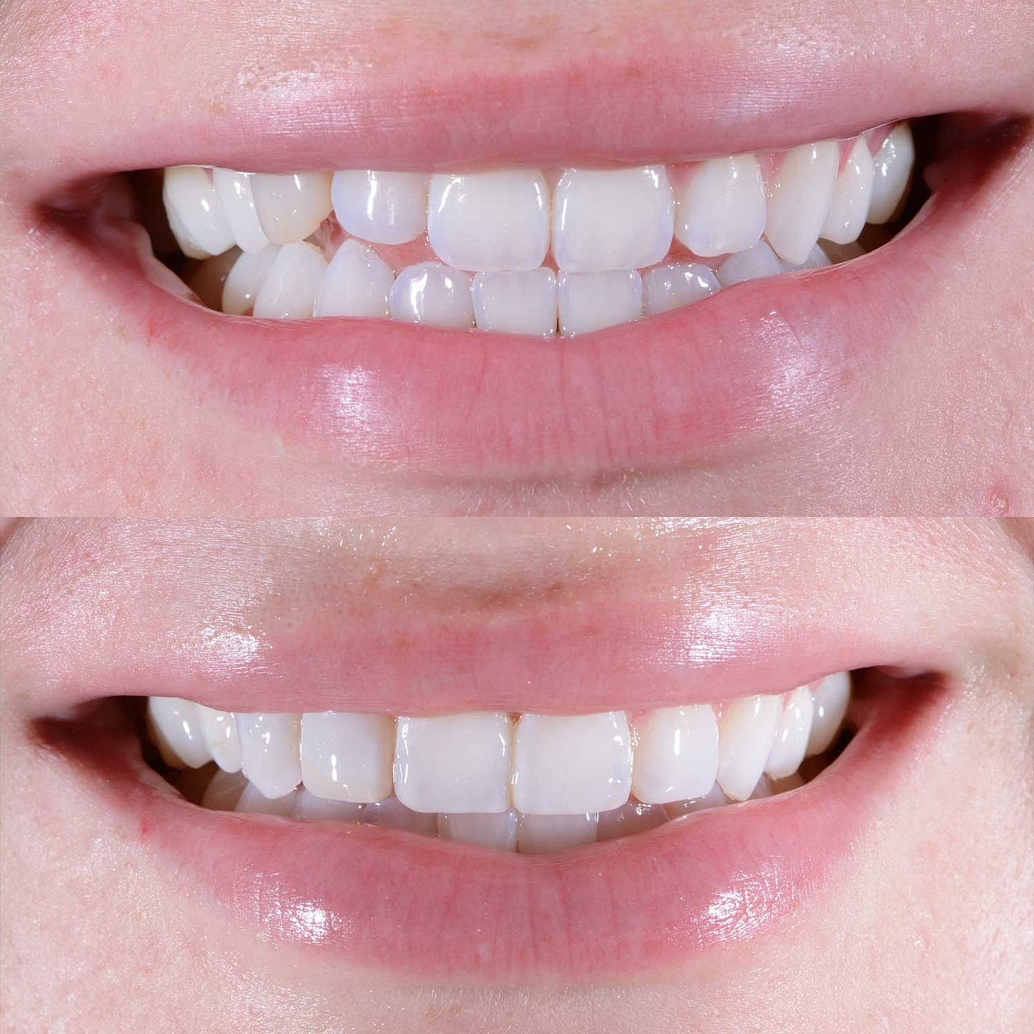 Direct Bonding Before & After
