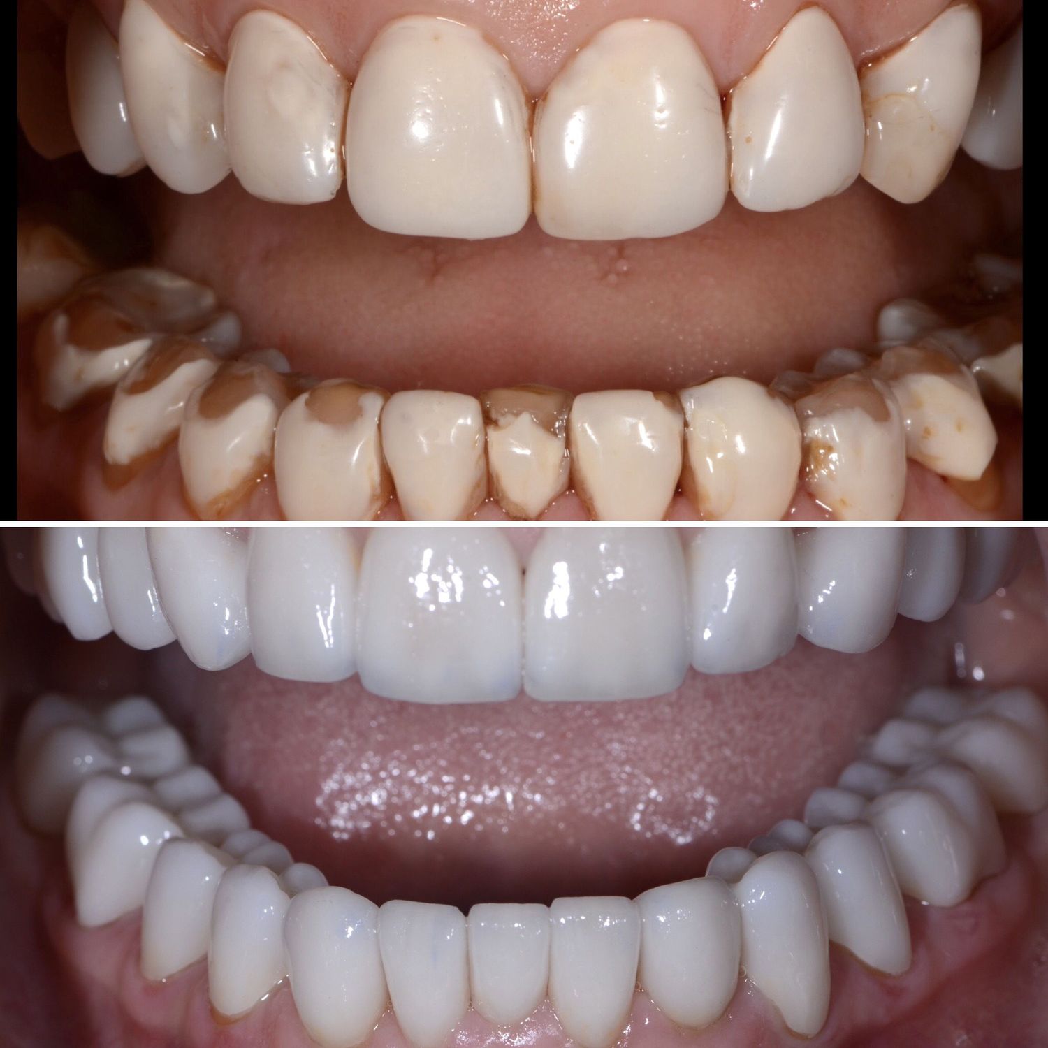 Porcelain Crown Veneers Before & After