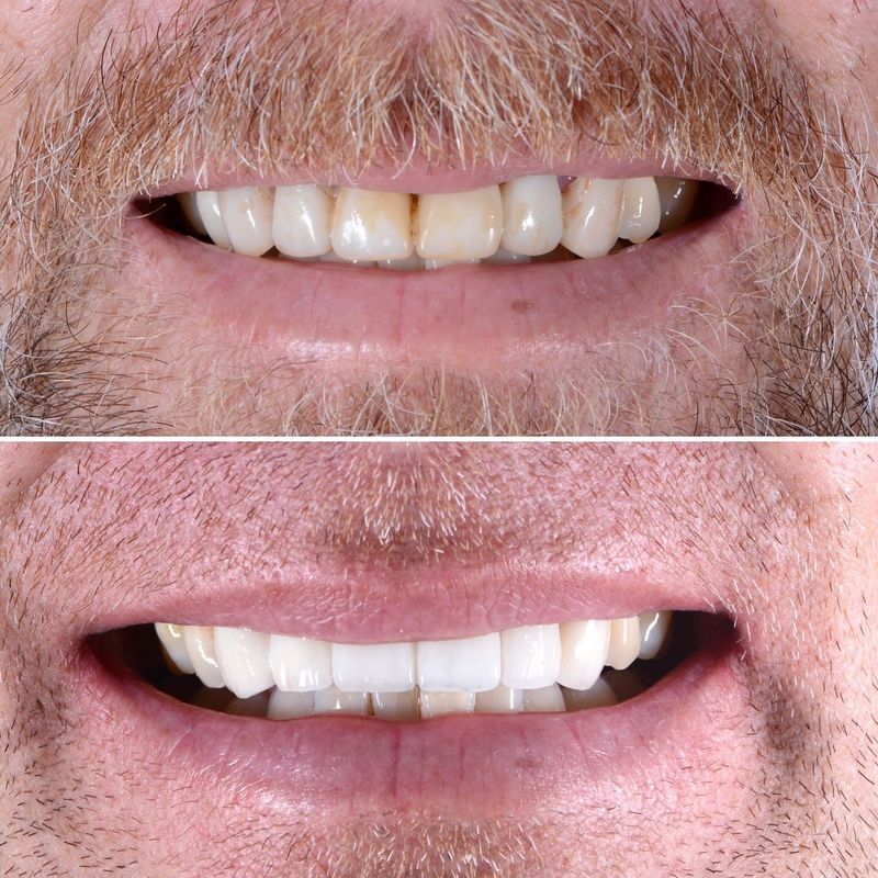 Porcelain Crown Veneers Before & After