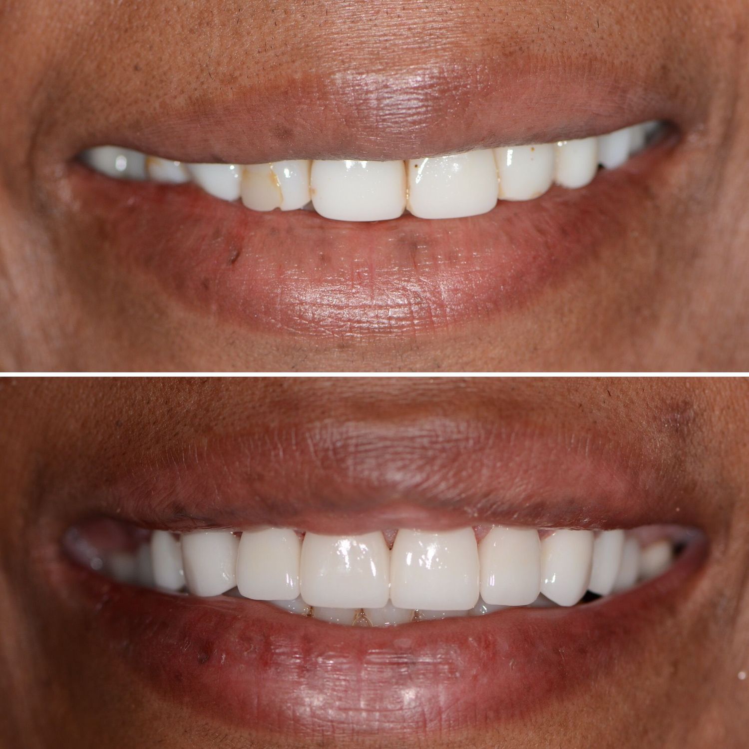 Porcelain Crown Veneers Before & After