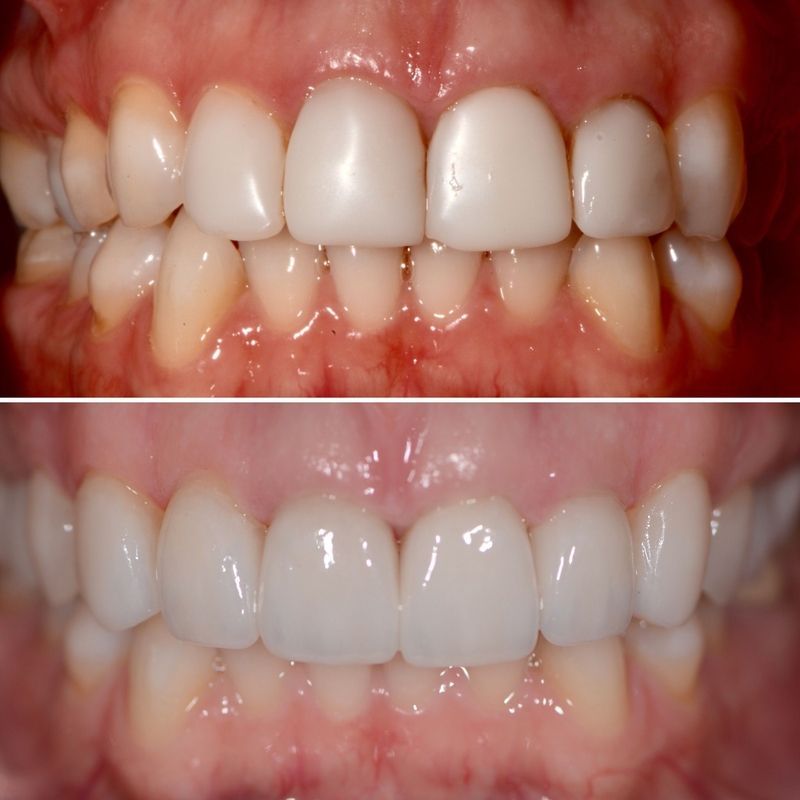 Porcelain Crown Veneers Before & After