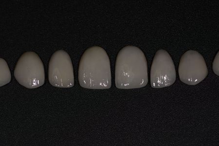 Porcelain Crown Veneers Before & After