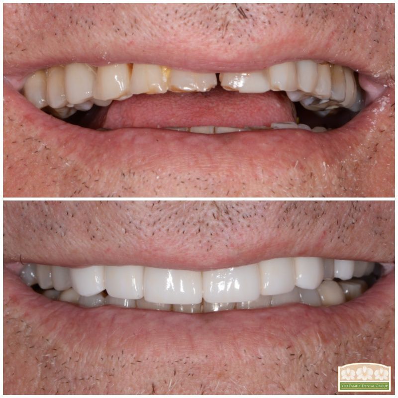 Porcelain Crown Veneers Before & After