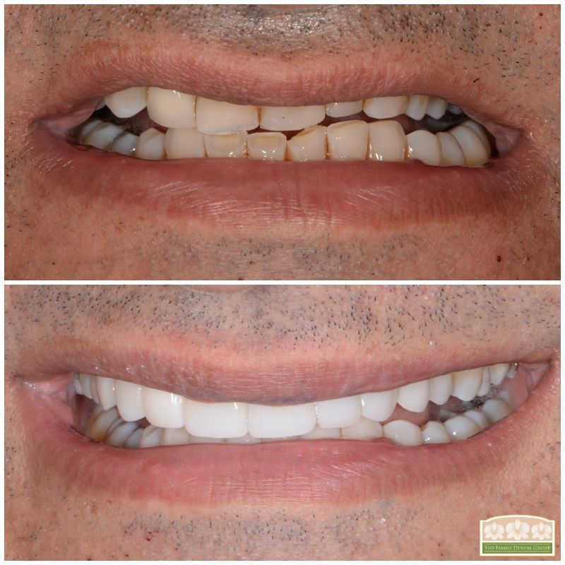 Porcelain Crown Veneers Before & After