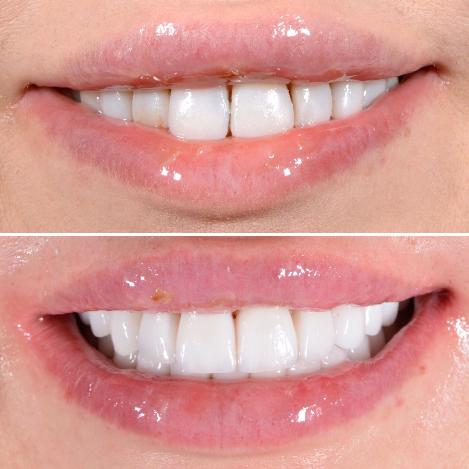 Porcelain Crown Veneers Before & After