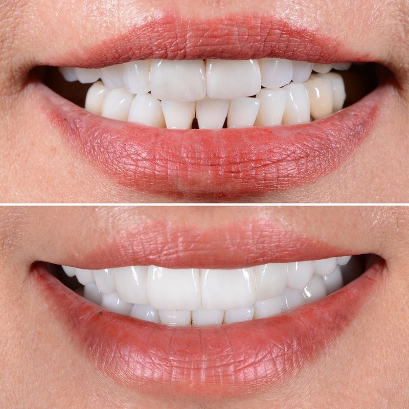 Porcelain Crown Veneers Before & After