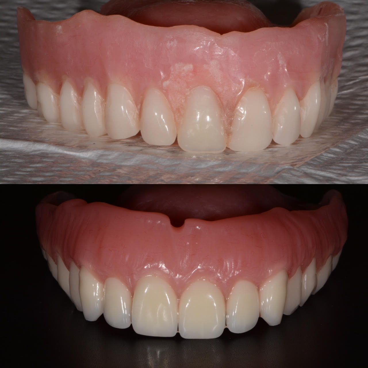 Geneva Dentures Before & After