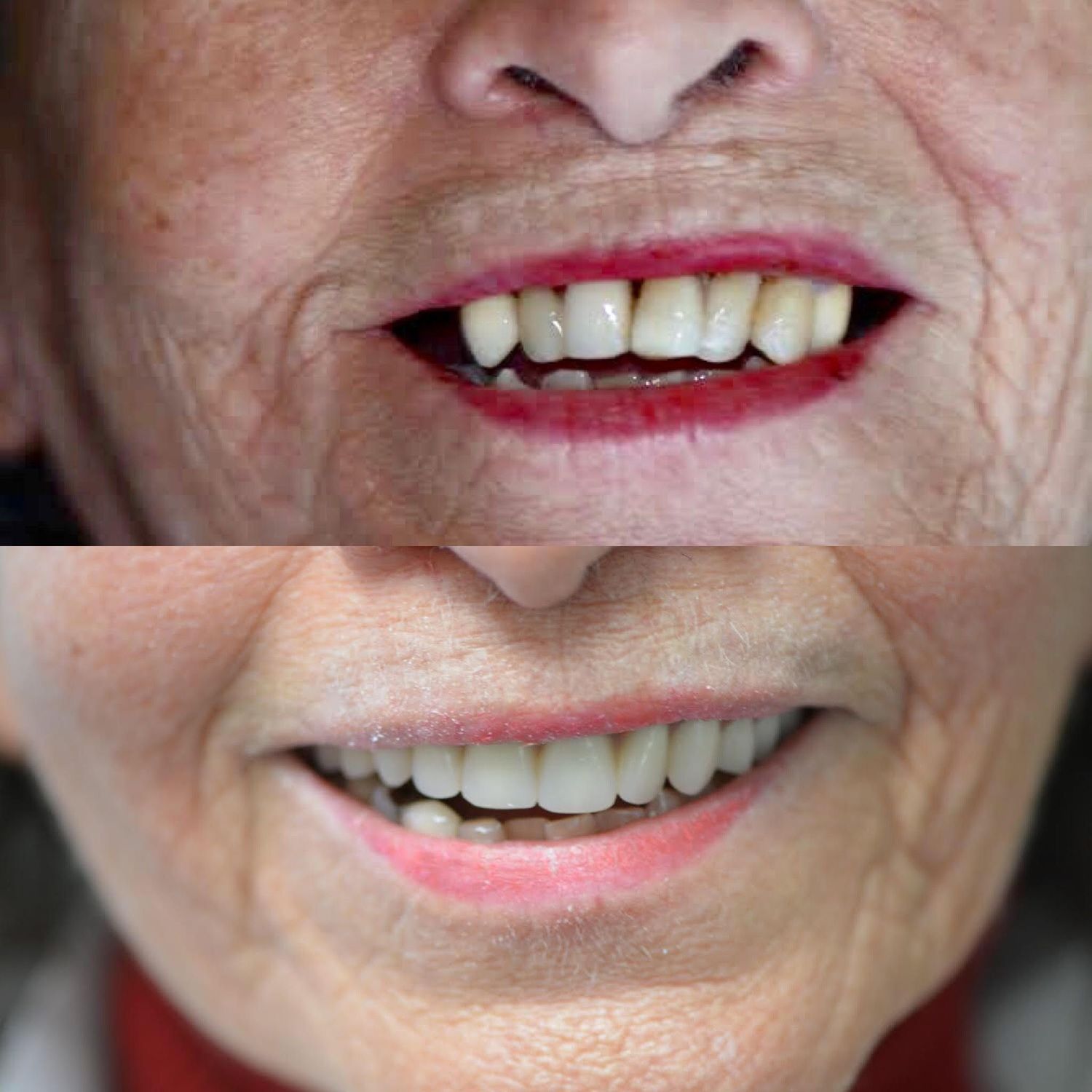 Geneva Dentures Before & After