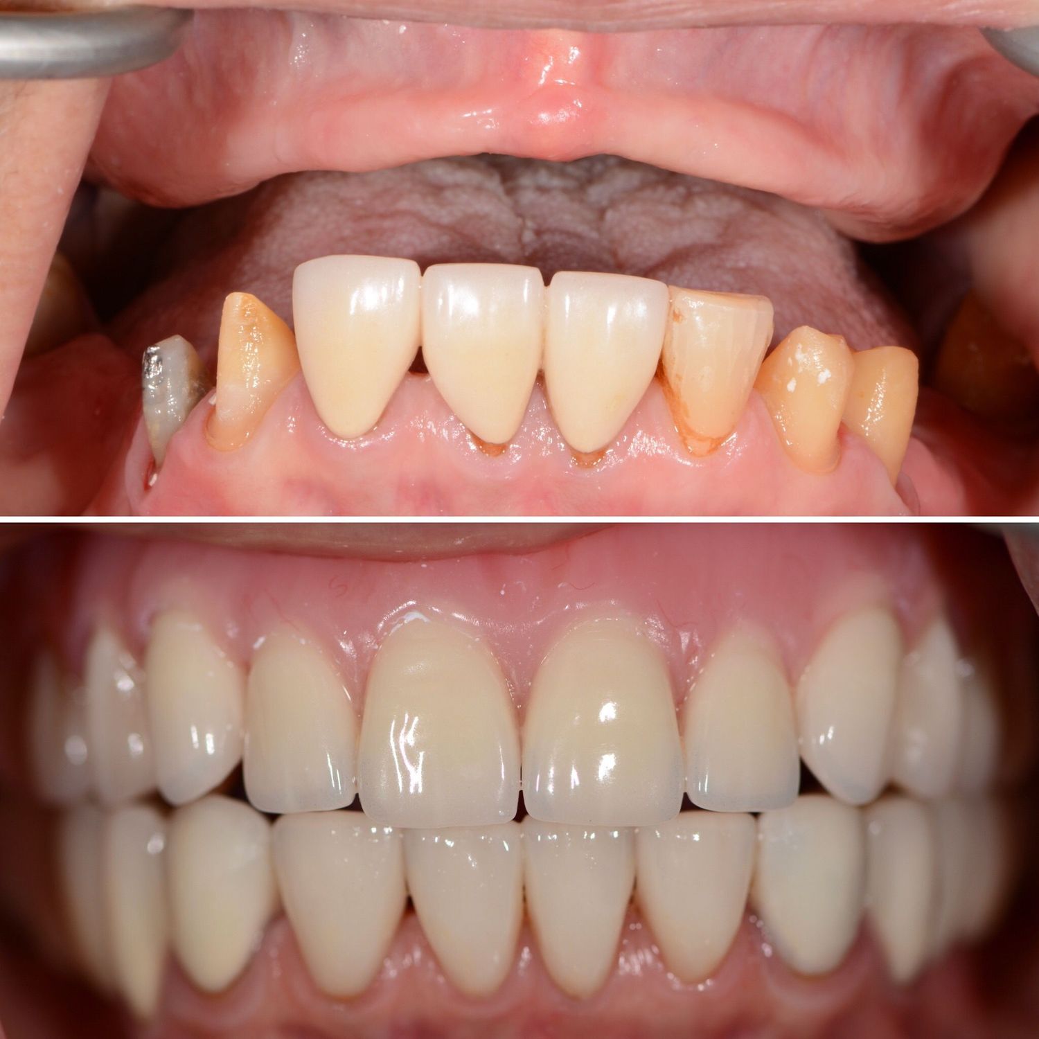 Geneva Dentures Before & After