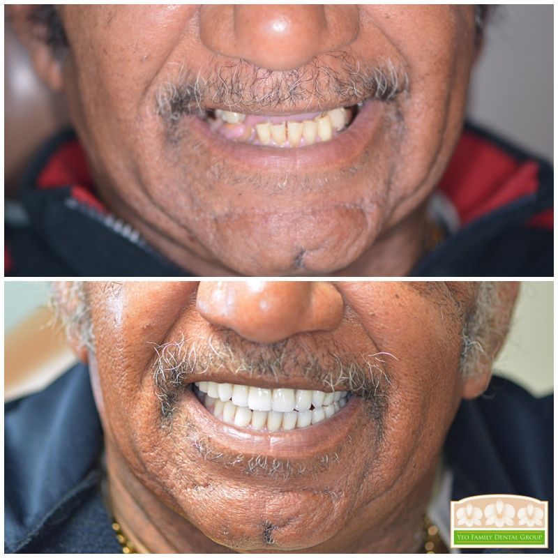 Geneva Dentures Before & After