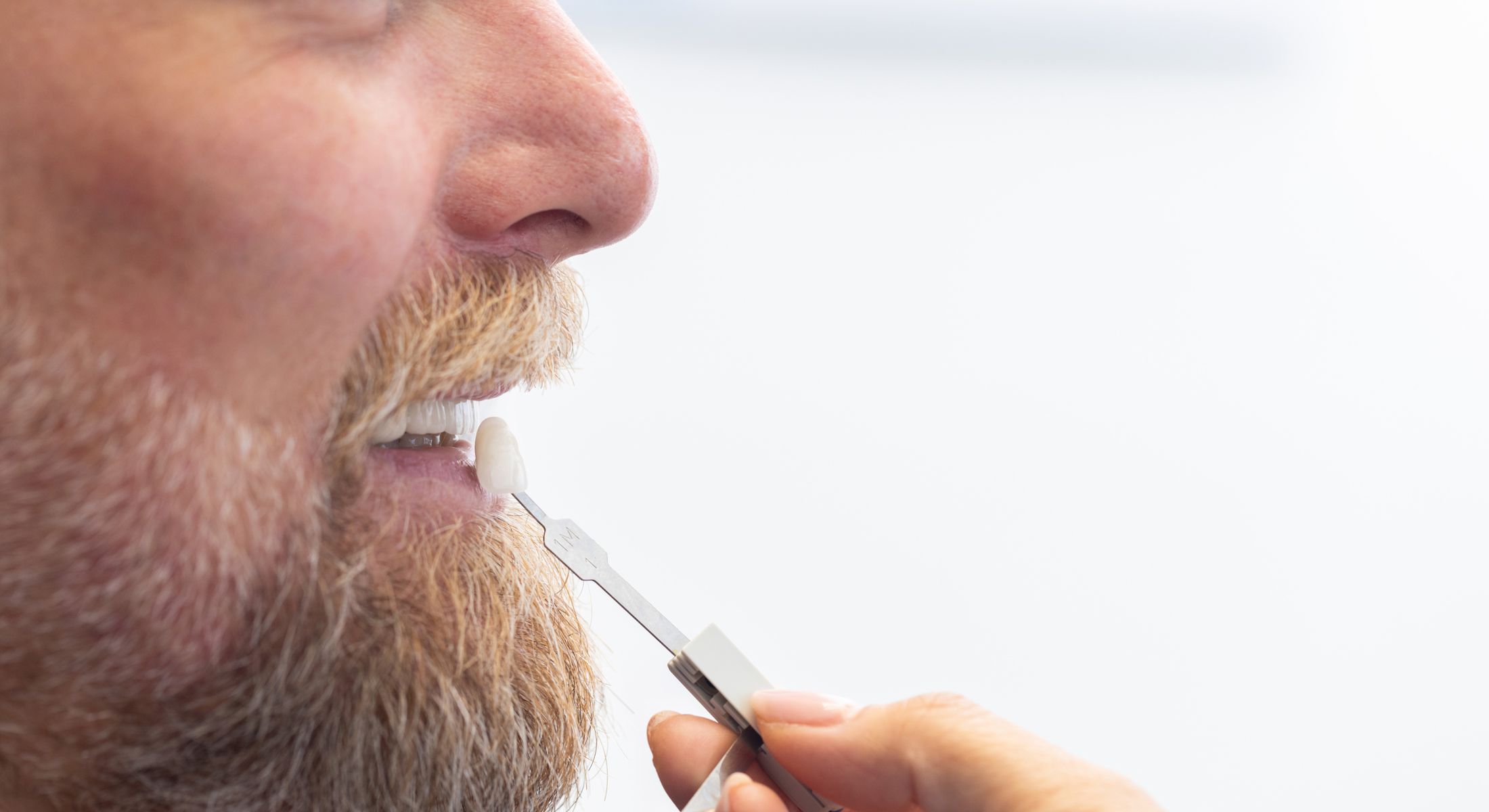 marina del rey cosmetic dental model with beard